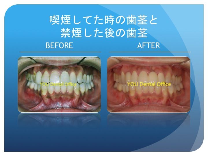 歯茎が黒い 歯周病とタバコの関係 横浜市星川の矯正歯科 ゆうデンタルオフィス