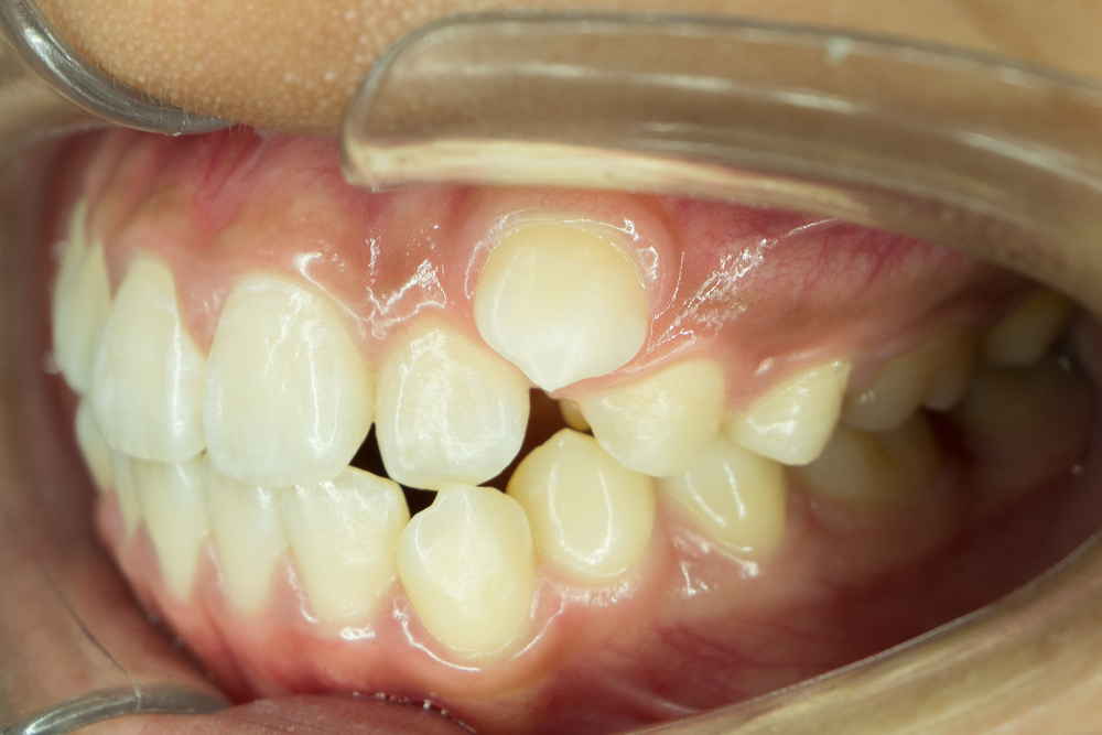 八重歯の予防に犬歯を抜く それは止めた方が良い５つの理由 横浜市星川の矯正歯科 ゆうデンタルオフィス