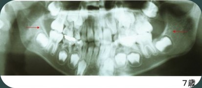 子供の親知らず 下の親知らずの早期抜歯の最適な時期と方法 横浜市星川の矯正歯科 ゆうデンタルオフィス